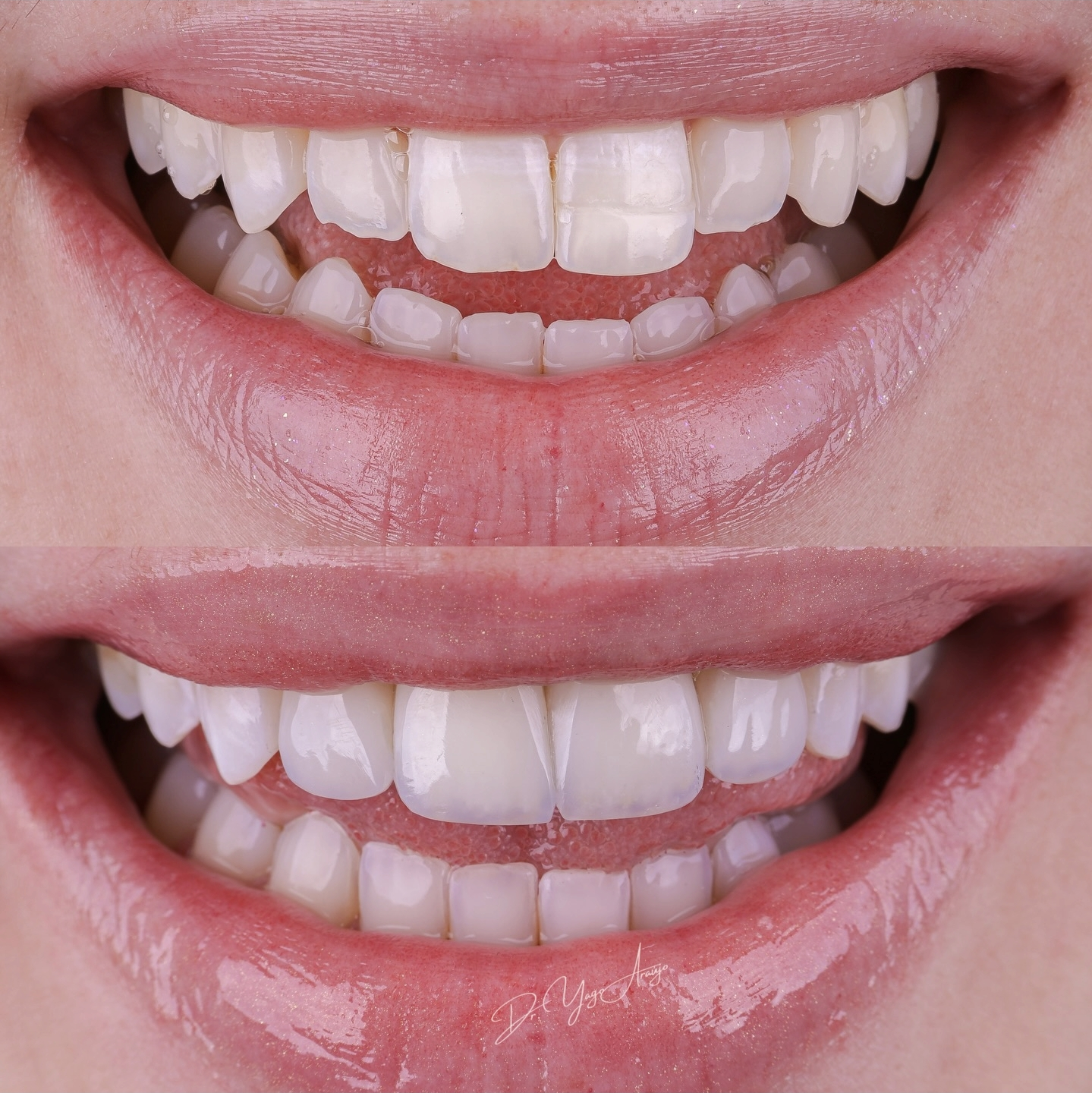 Caso real — correção de espaçamento entre dentes com lentes de resina